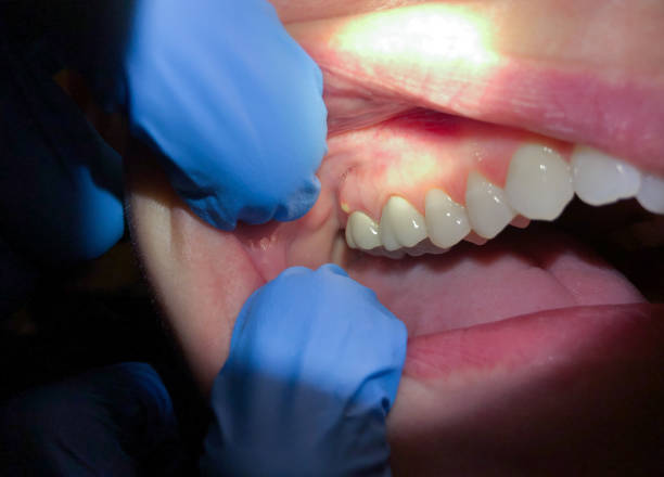 Best Dentist for Tooth Abscess  in Oak Ridge, NC